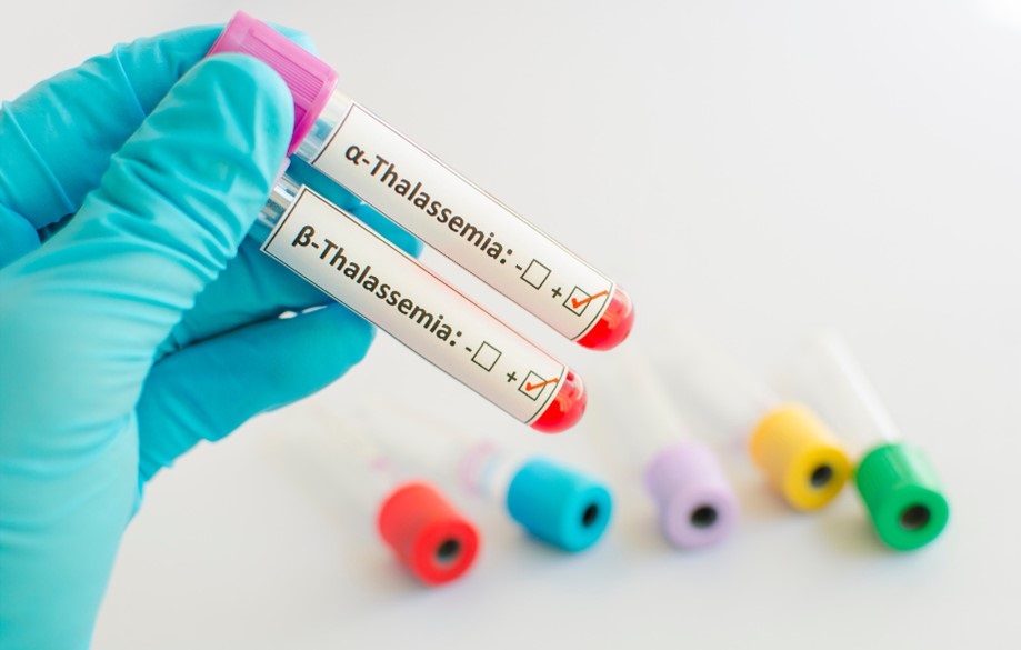 thalassemia test vial containing blood