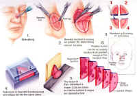 A schematic diagraming the stages of 莫氏显微手术 showing the steps to remove the cancer.