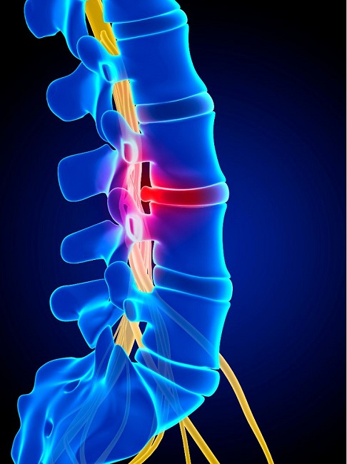 herniated disc
