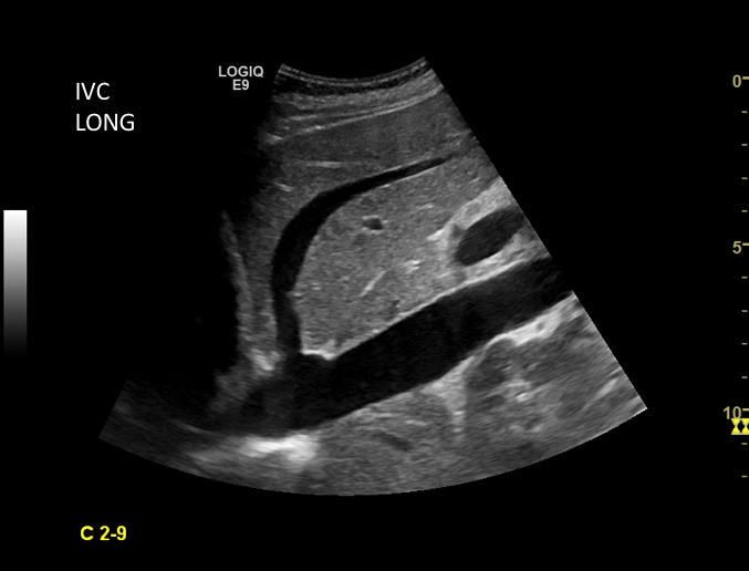 ivc long with hepatic and right atrium