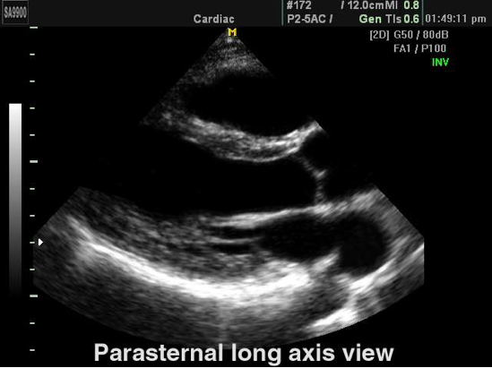 parasternal long axis